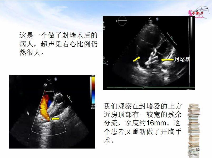 心脏扩大的超声诊断思路