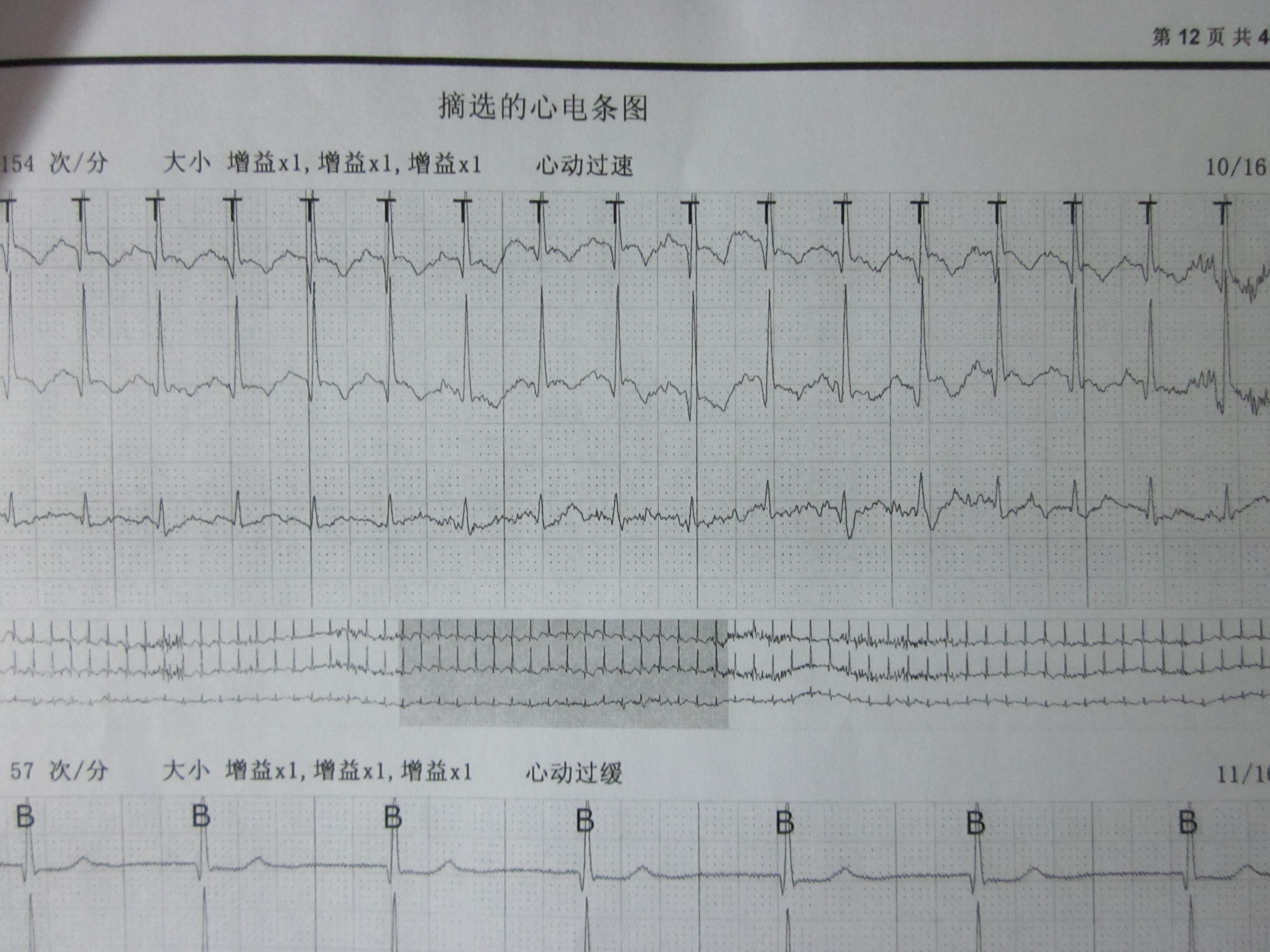 房早二联律还是窦性心律不齐?