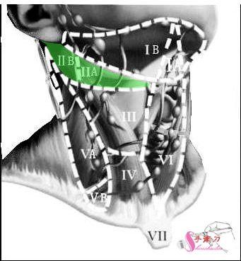 颈部淋巴结分区法示意图