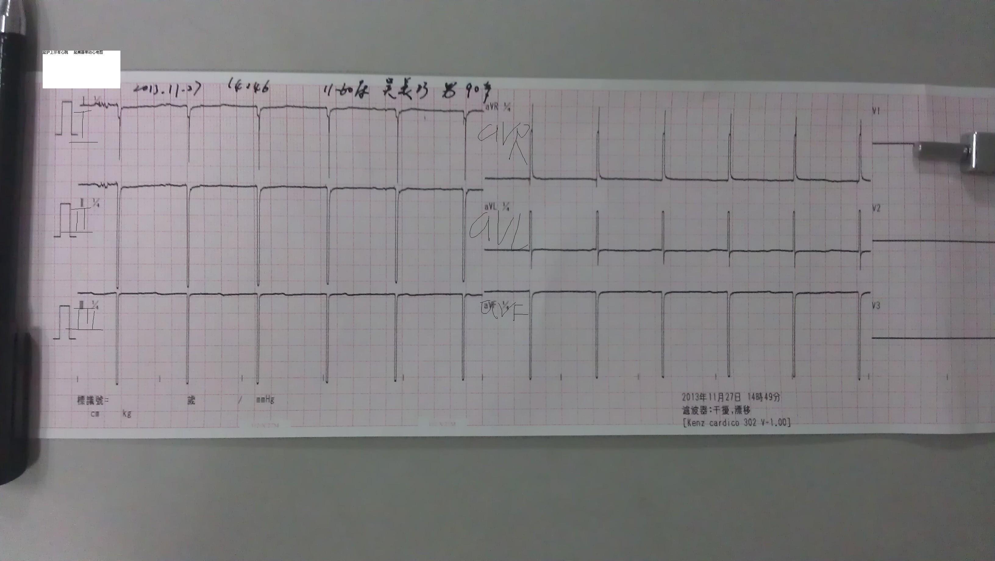 请山羊老师trg老师及各位老师帮忙看看 起搏器心电图 急急急!