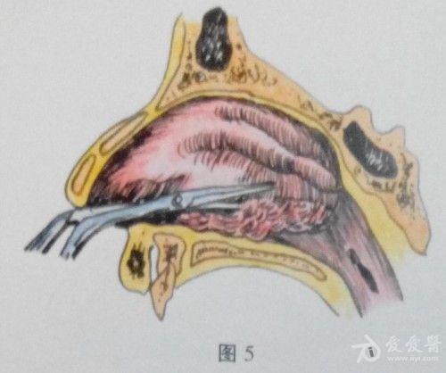 耳鼻咽喉头颈外科手术征集—下鼻甲部分切除术