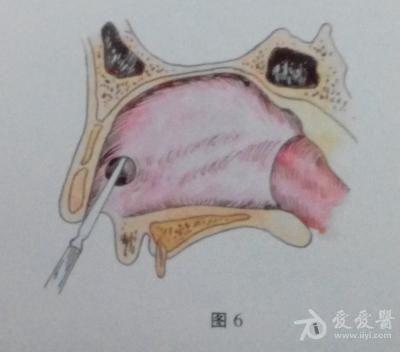 耳鼻咽喉头颈外科手术征集鼻中隔穿孔修补术