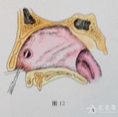 耳鼻咽喉头颈外科手术征集——鼻中隔穿孔修补术