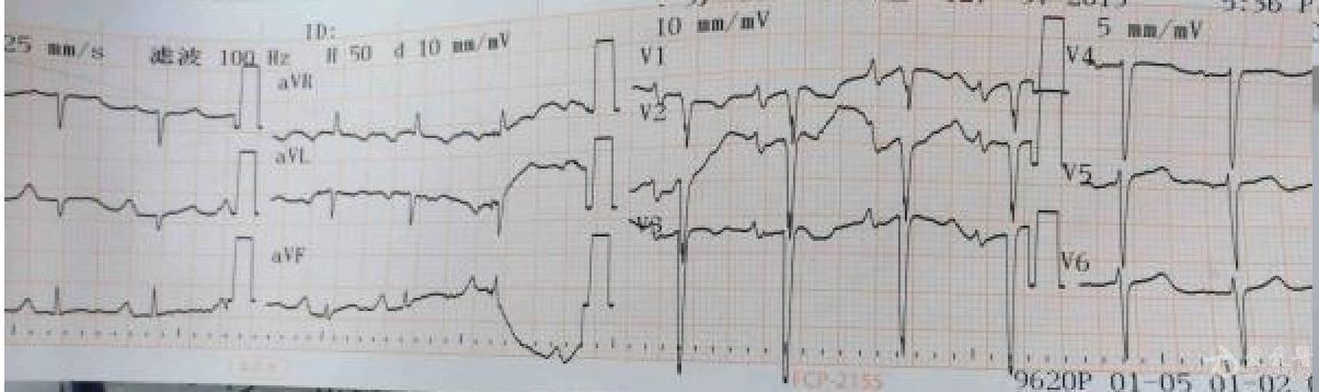 zt12345 -男-肺心病患者-胸导联qrs负向一致性.jpg