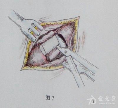 耳鼻咽喉头颈外科手术征集——鼻腔粘膜下埋藏术