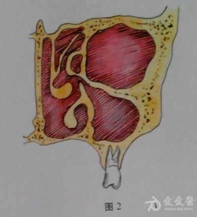 耳鼻咽喉头颈外科手术征集鼻内筛窦开放切除术