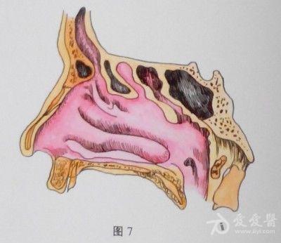 耳鼻咽喉头颈外科手术征集——鼻内筛窦开放切除术