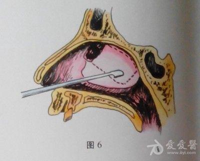 耳鼻咽喉头颈外科手术征集鼻内筛窦开放切除术