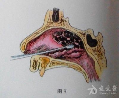 耳鼻咽喉头颈外科手术征集鼻内筛窦开放切除术