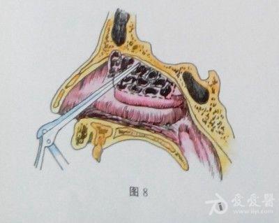 征集——鼻内筛窦开放切除术  ④清除腔内病变组织(图8),直至蝶窦前壁