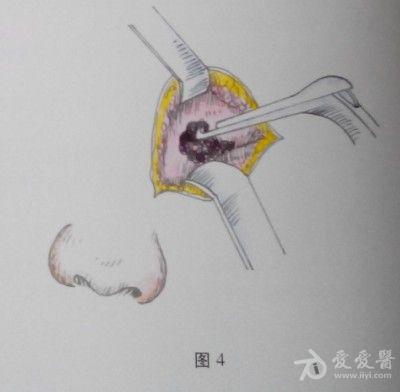 耳鼻咽喉头颈外科手术征集鼻外额窦根治术