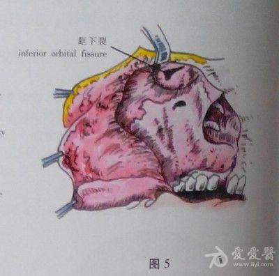 耳鼻咽喉头颈外科手术征集上颌骨全切除术