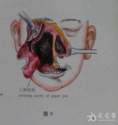 耳鼻咽喉头颈外科手术征集——上颌骨全切除术