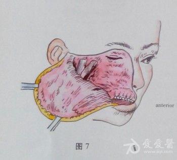 ⑥分离皮瓣,显露眼窝,上颌窦前壁和后外侧壁,颧骨及下颌关节腮腺组织