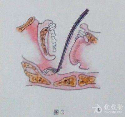 耳鼻咽喉头颈外科手术征集——增殖体(腺样体)切除术