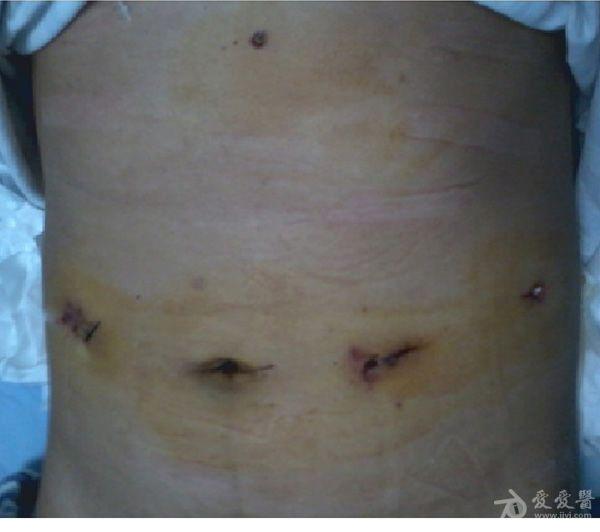 华西医院胰腺外科李可洲教授成功完成一例完全腹腔镜胰腺中段切除手术