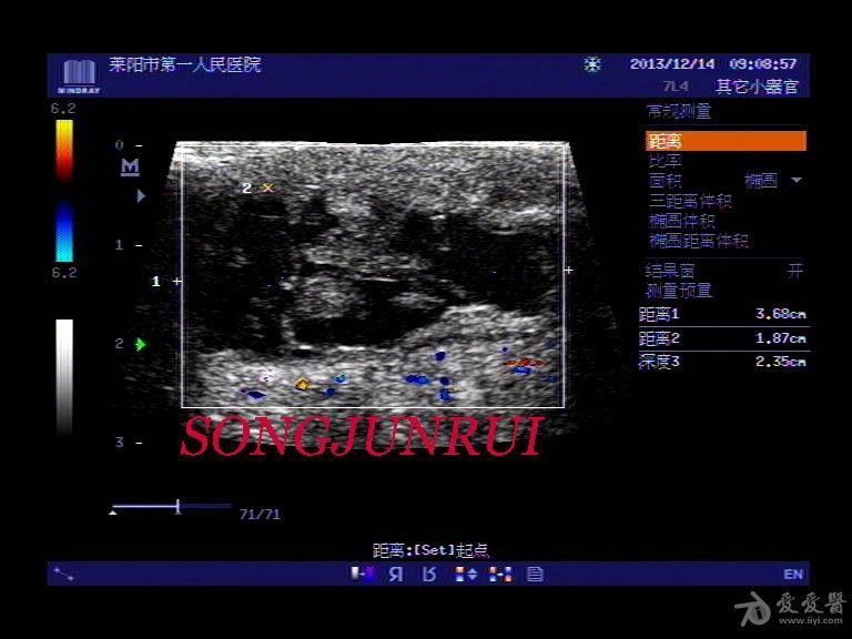 超声入门贴312肌骨超声鹰嘴滑囊炎超声图体表图