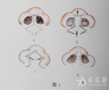 上唇皮瓣法:采用上唇皮肤伸展成形鼻小柱(图1).