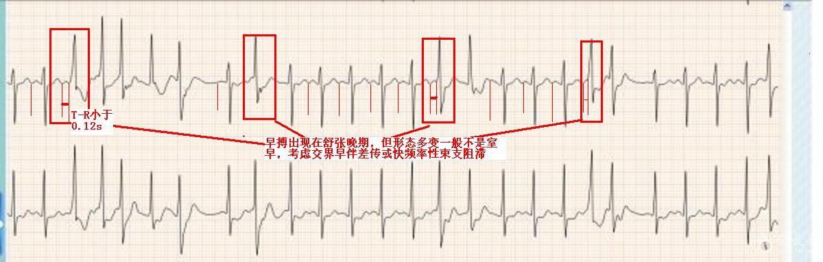 早搏出现在舒张晚期,但形态多变一般不是室早,考虑交界早伴差传或快