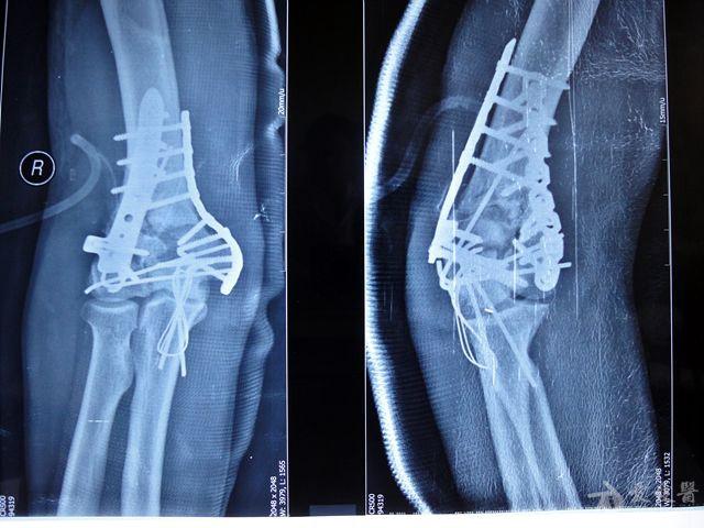 年终奉献肱骨髁间粉碎开放骨折