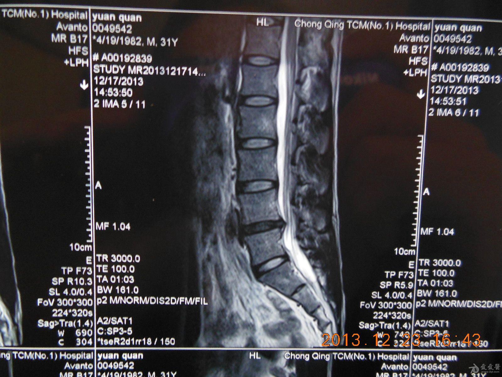 腰椎l4/5椎间盘向右后突出,双侧椎间孔狭窄右侧严重些,其他大致正常