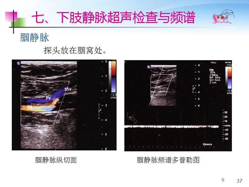 下肢血管的超声检查及正常声像图