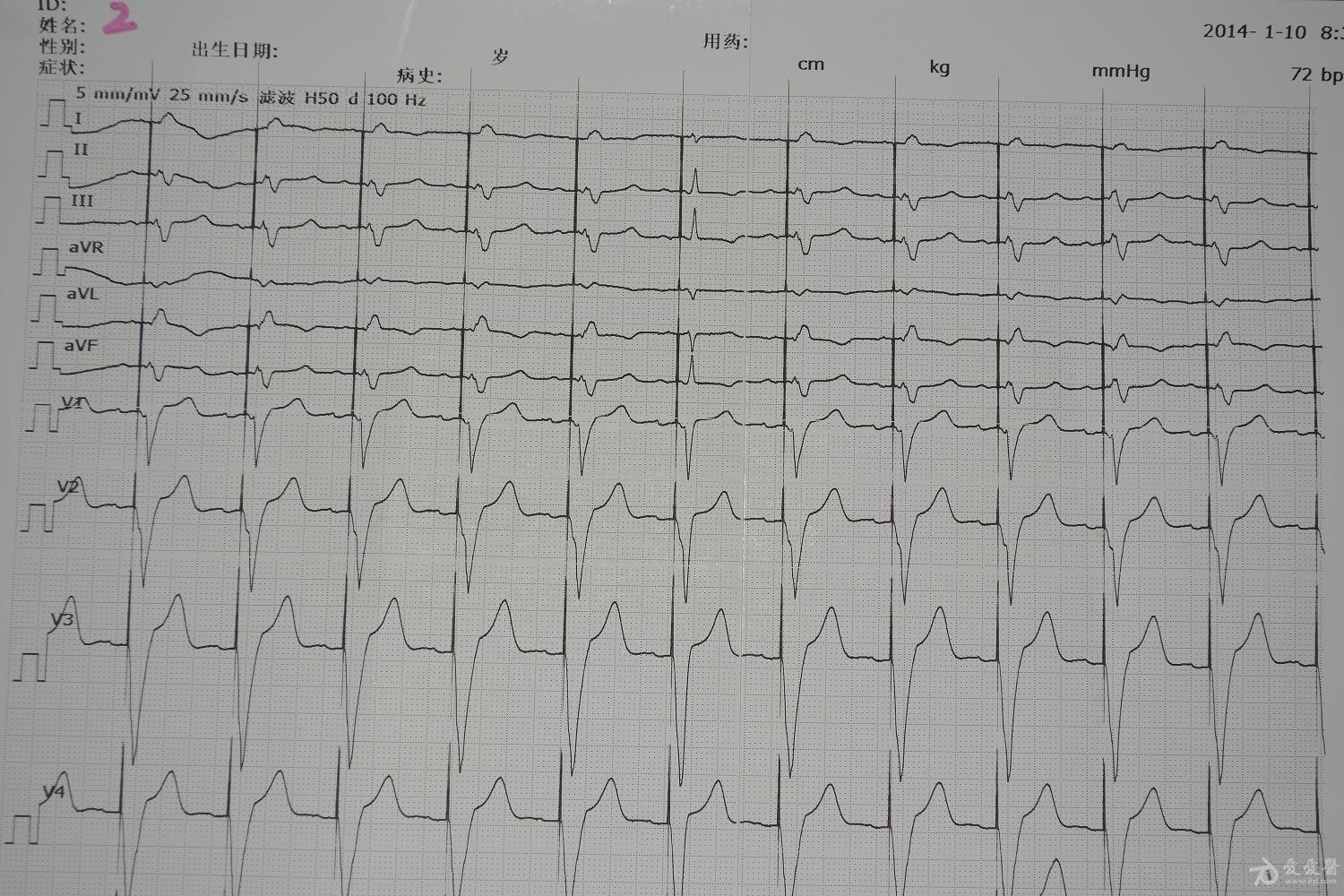 请版主和高手帮忙看一下起搏器心电图23