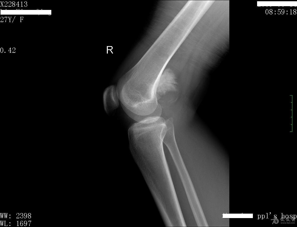 病例39:右大腿下端疼痛,下蹲受限2月余(骨肉瘤)