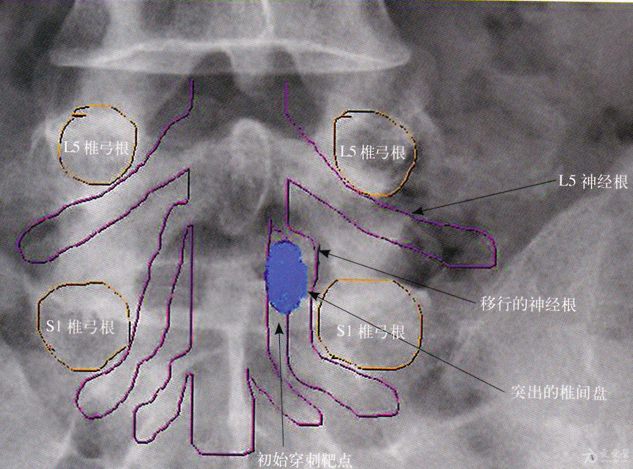 应用脊柱内窥镜经椎板间隙入路治疗腰椎间盘突出症一例报告椎间孔镜l5