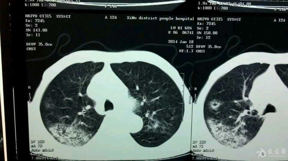 ct报告真菌性肺炎 怀疑 请高手指点