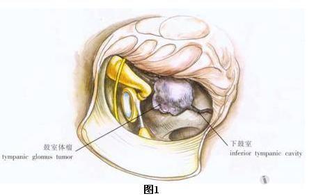 耳鼻咽喉头颈外科手术征集——鼓室体瘤切除术