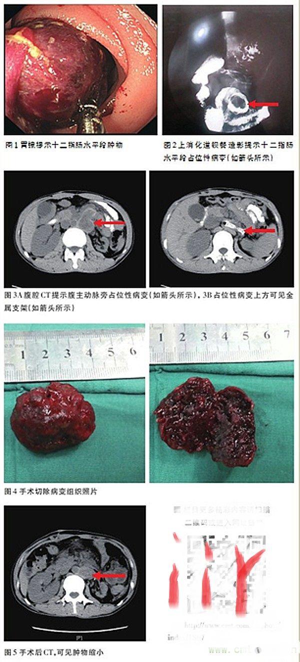 肾假性动脉瘤消化道大出血