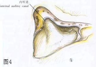 将岩骨板用电钻或咬骨钳切除,乙状窦板处可保留一小片骨岛以保护乙状