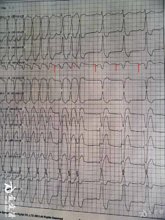 完左,室上速 心电图脑电图专业讨论版 爱爱医医学论坛