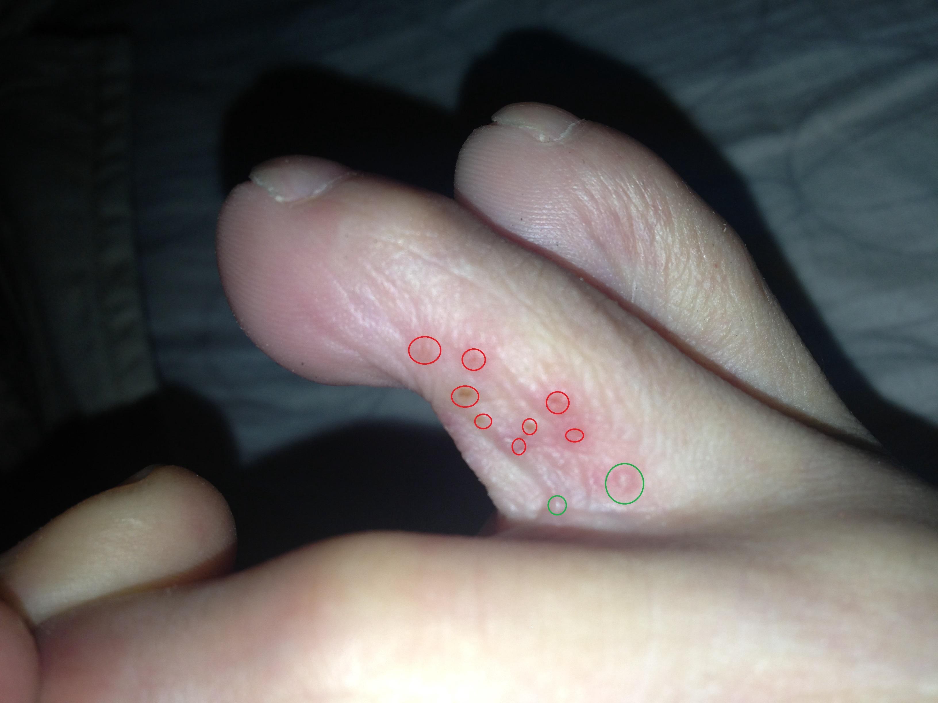 请诊断脚趾跟脚趾之间很多粒小水泡
