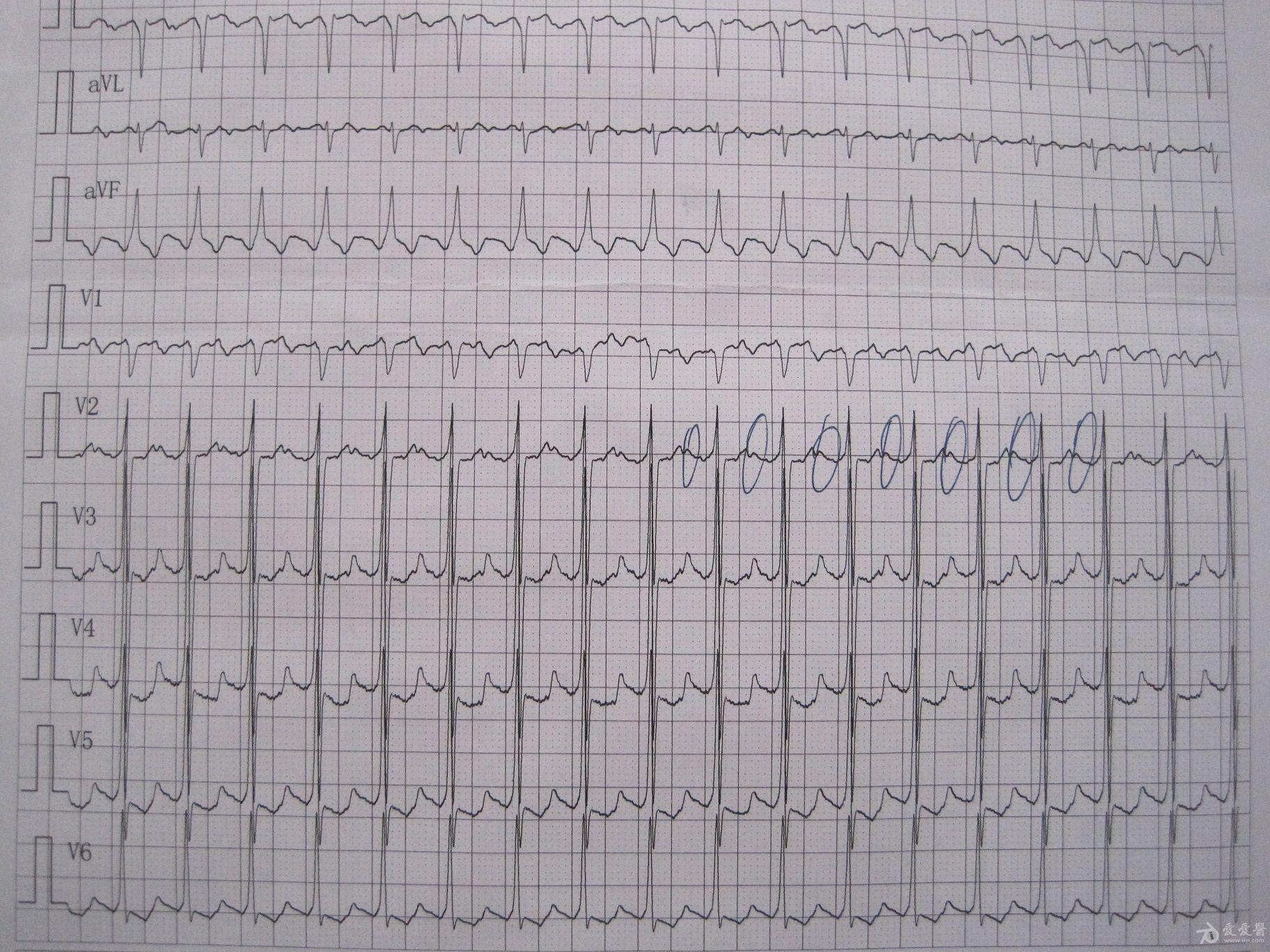 请教山羊老师及各位版主 是2:1房扑还是窦速一度?