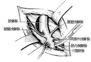 大隐静脉手术问题