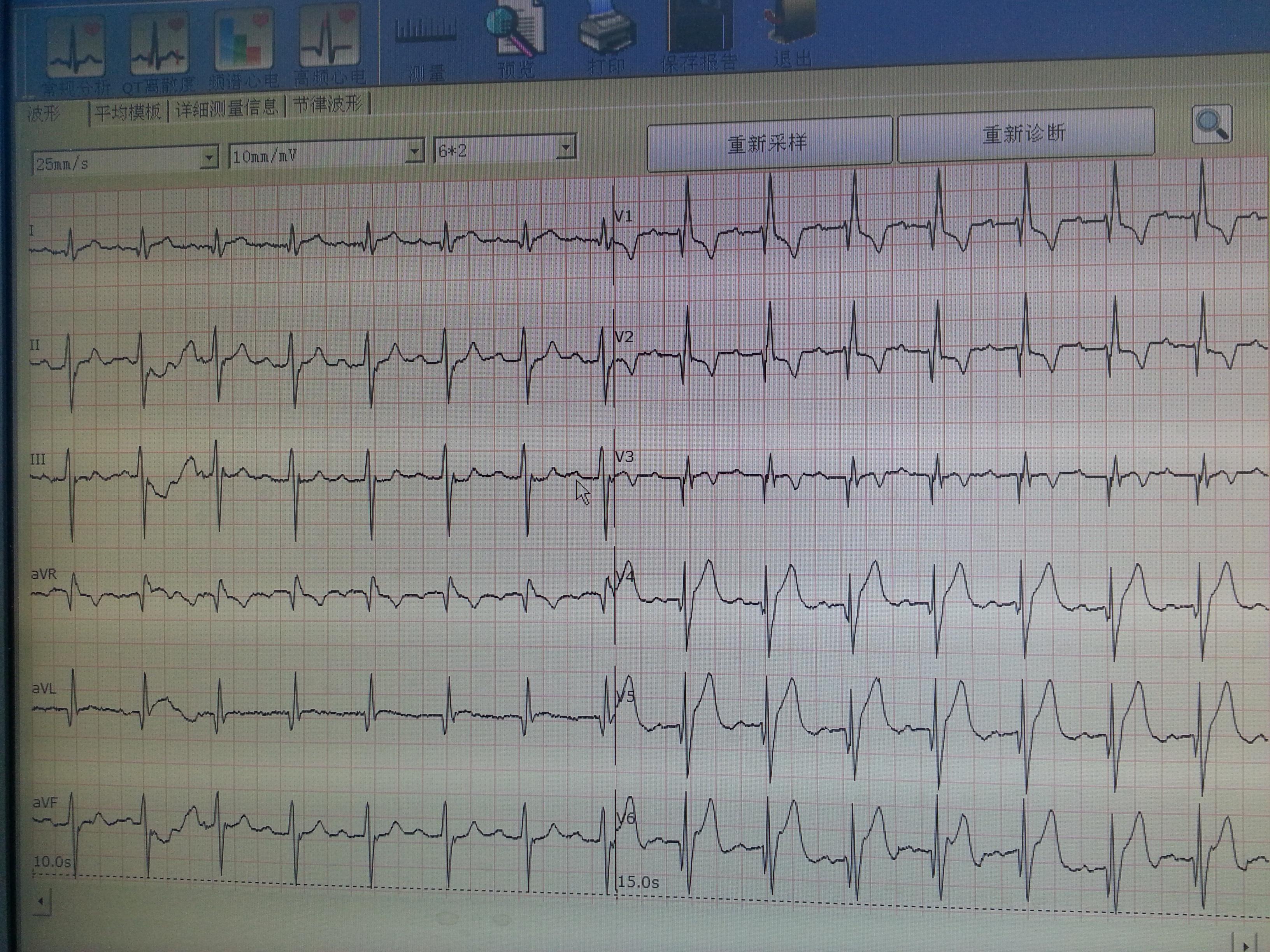 患者,男84岁,50天前因心梗住院治疗,这是今天20秒内的2张心电图