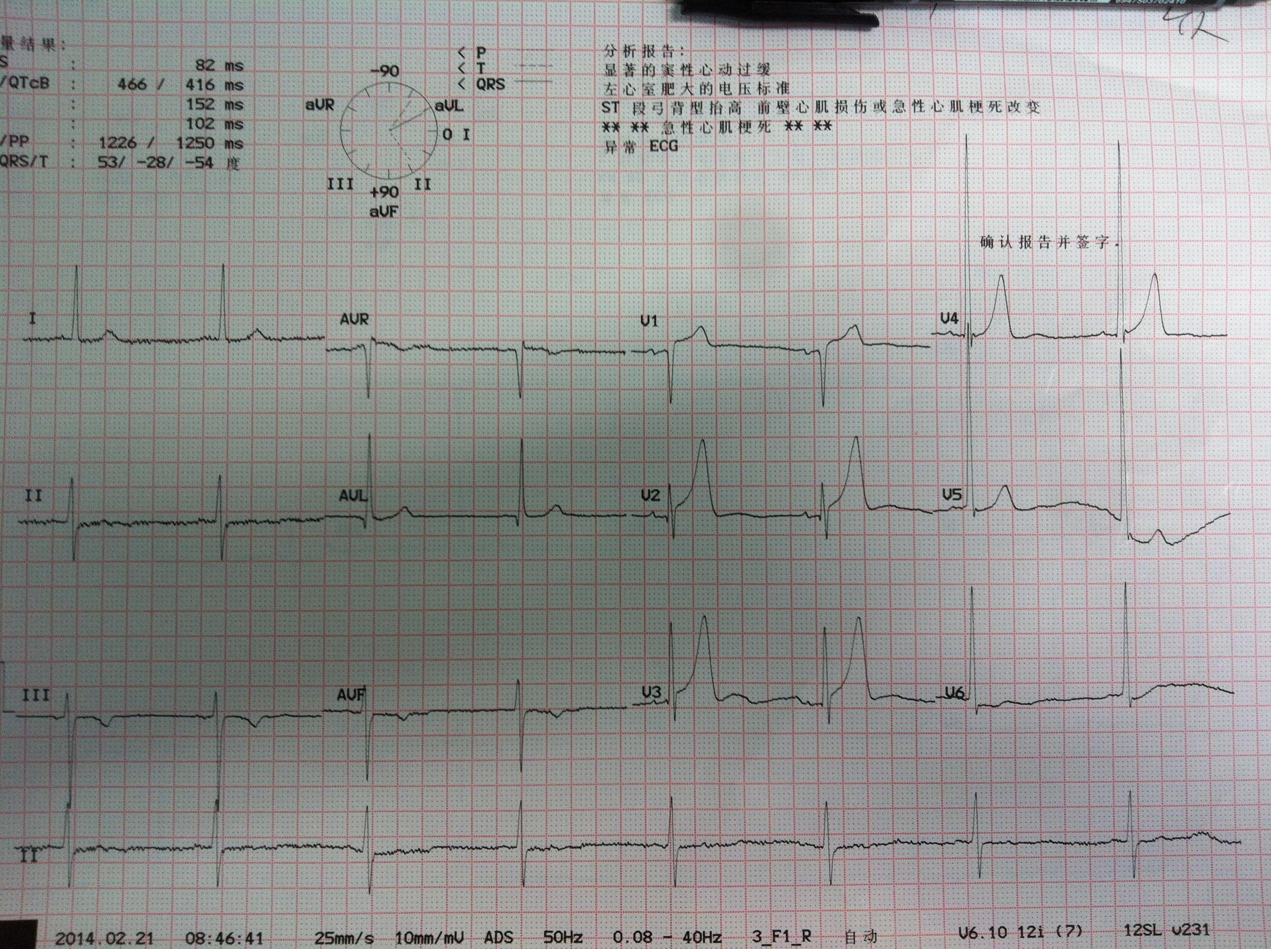 请高手指教二个心电图