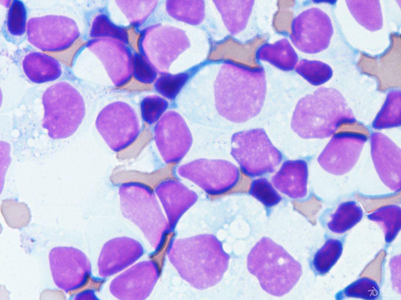 胸水细胞病理学:瑞士-吉姆萨染色