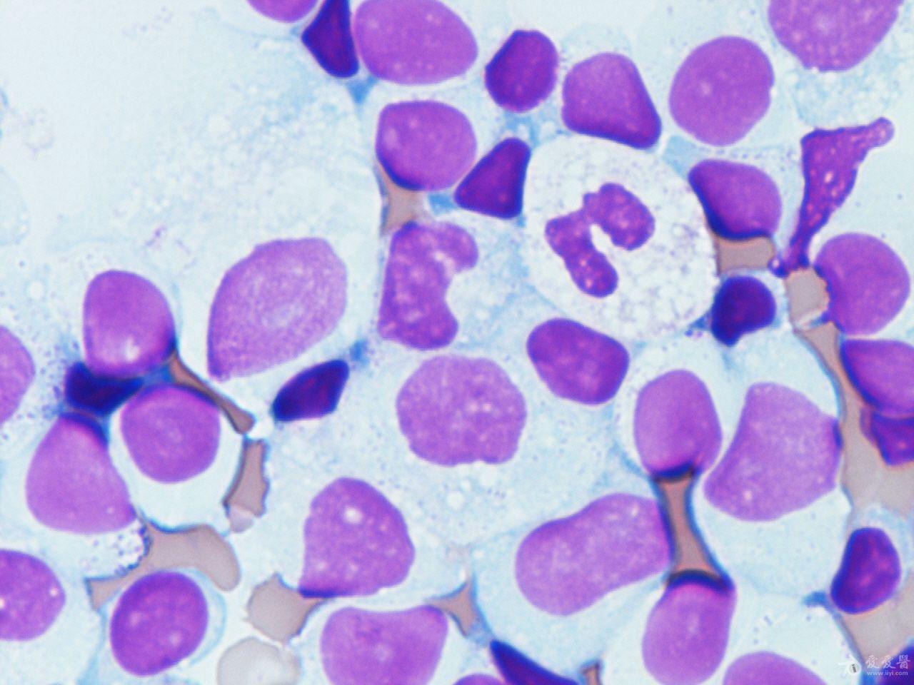 胸水细胞病理学:瑞士-吉姆萨染色