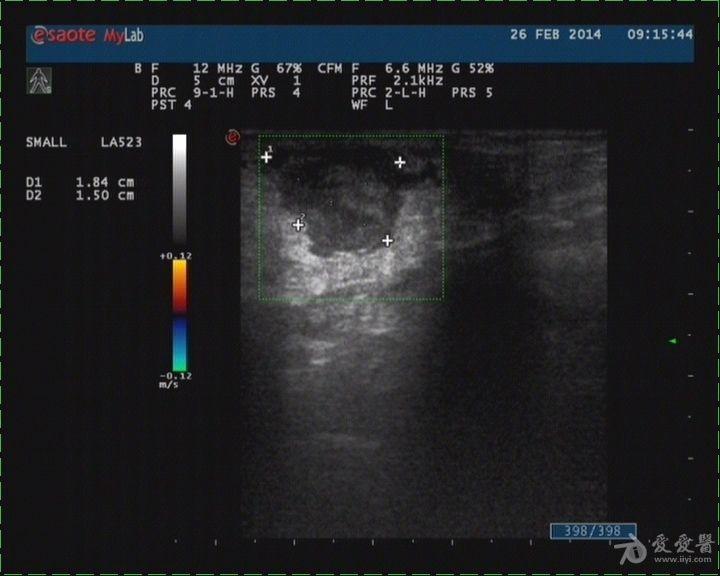 脂肪瘤?还是炎症包块 超声医学讨论版 爱爱医医学论坛