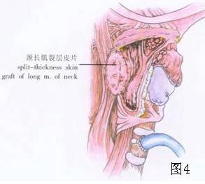 耳鼻咽喉头颈外科手术征集——保留喉功能的下咽后壁区癌切除术