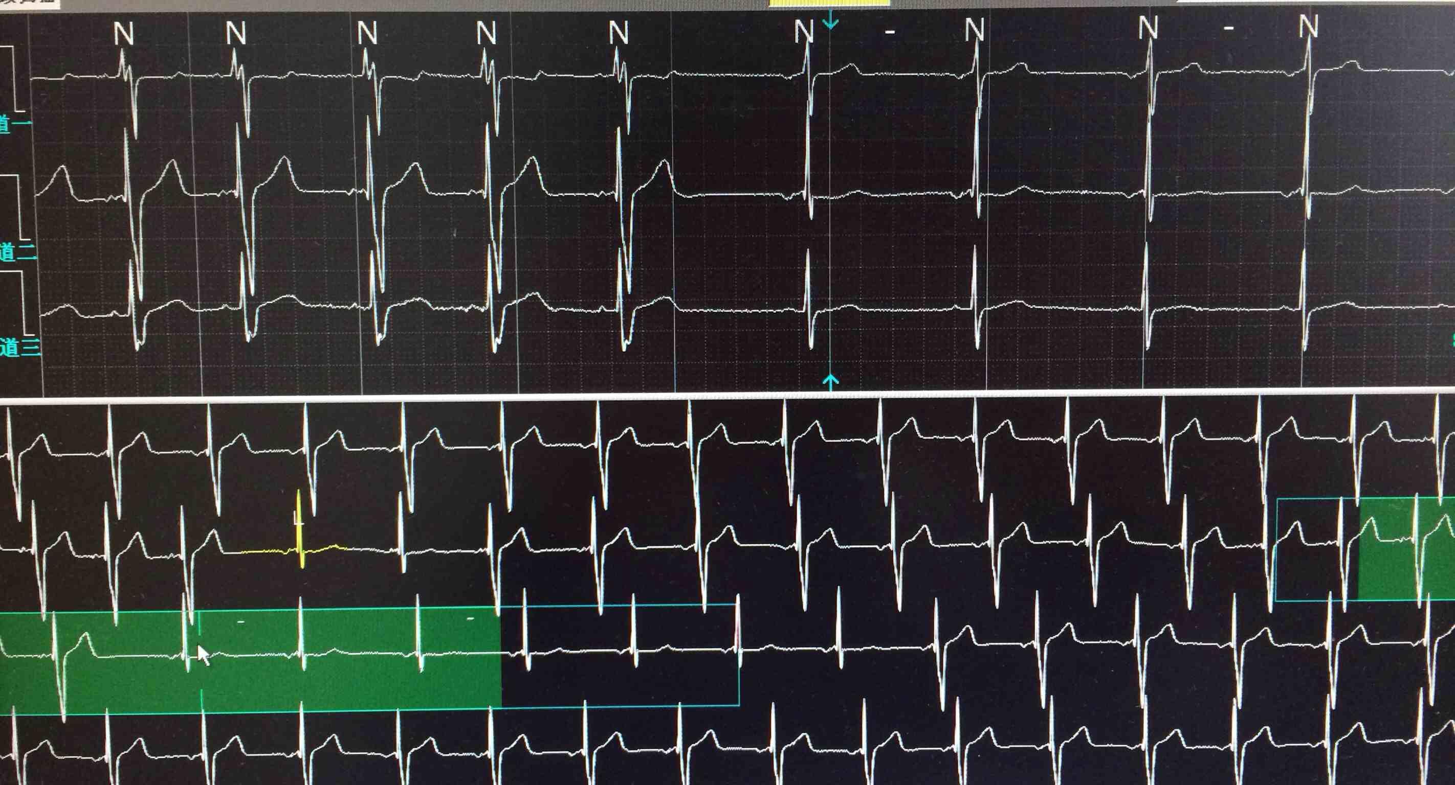 三通道动态心电图