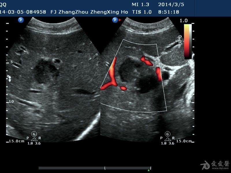 肝脓肿两例 - 超声医学讨论版 - 爱爱医医学论坛