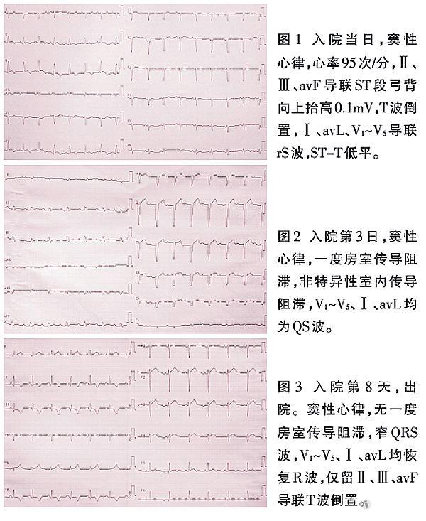 【优秀病例展示活动】 (转帖) 《急性心肌炎或心肌梗死?》