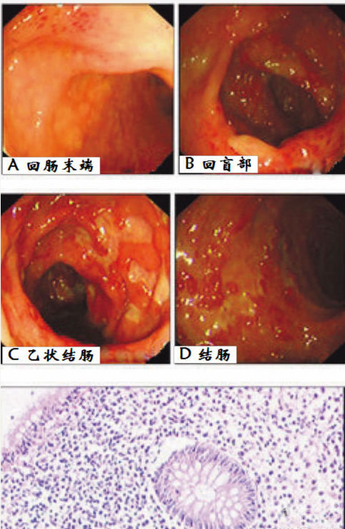 重度溃疡性结肠炎患者的内外科诊治体会