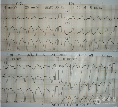 【优秀病例展示活动】 (转贴) 心律失常讨论:室速?室上速并差传?