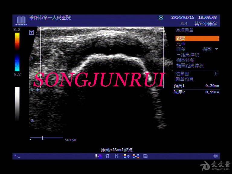 超声入门贴351股骨骨软骨瘤超声图x线表现