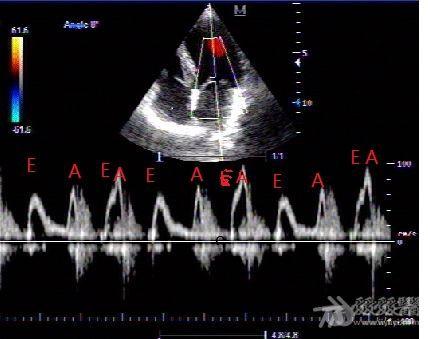 这样的二尖瓣频谱怎样测量 - 超声医学讨论版 - 爱爱